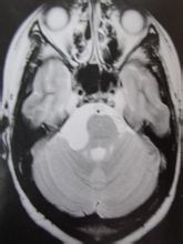 類表皮嚢胞 - ページ [1] - 世界百科事典の知識