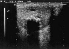 類表皮嚢胞 - ページ [1] - 世界百科事典の知識