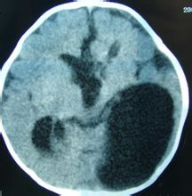 類表皮嚢胞 - ページ [1] - 世界百科事典の知識